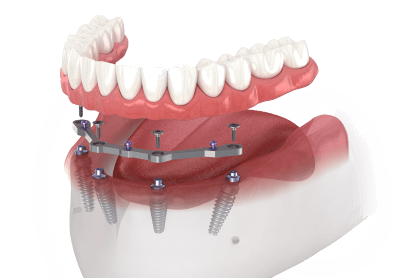 Full-Arch Dental Implants | Dentist in Missouri City, Texas